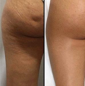Aceite Corporal Reafirma, Tensa e Hidrata la piel flácida